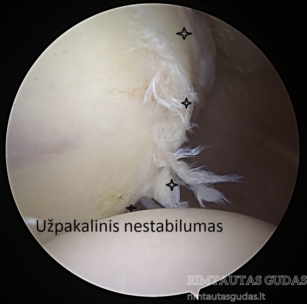 priemonės nuo peties sąnario artrozės skauda spindulių-tailed sandūrą nykščio