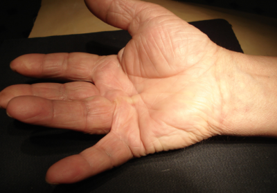 skauda pirštas kairėje jungtiniame artritas skausmas vertus