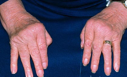 pablogėjimo bendrą artrito iš to ką atrodo artrozės kad peties sąnario