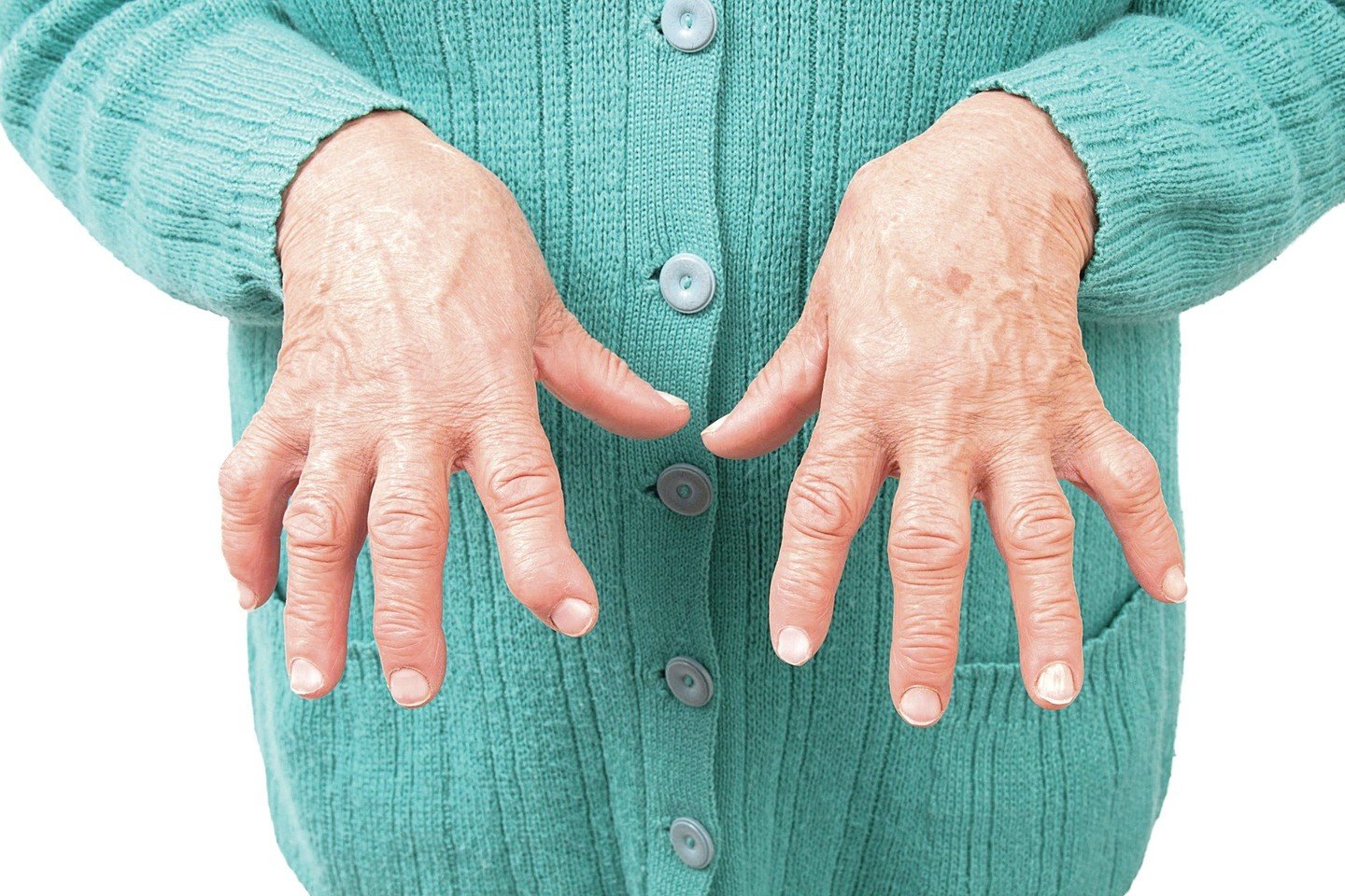 artritas pirštai kaip pašalinti skausmą prevencijos sąnariai