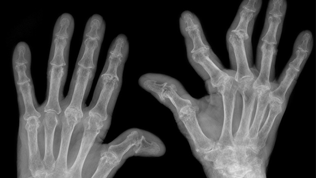 artritas hands kas yra liga
