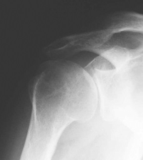 artritas osteoartrito sąnarių kaip pašalinti skausmą namuose sąnario