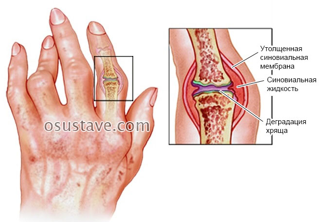 reumatoidinio artrito alkūnės sąnario sustaines apie eveny