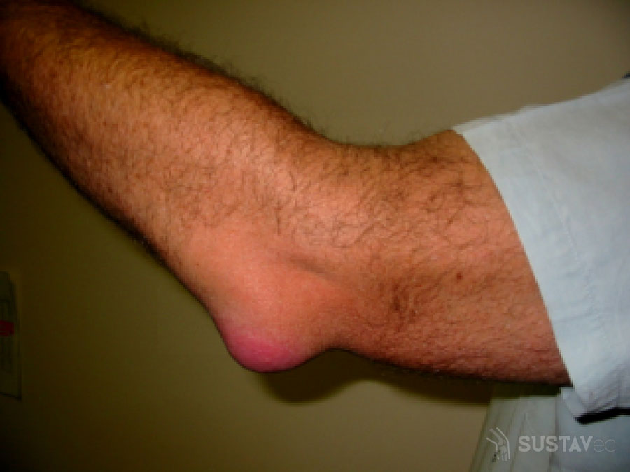 tradiciniais metodais kad gydymas sąnarių osteoartrito artritu sulčių