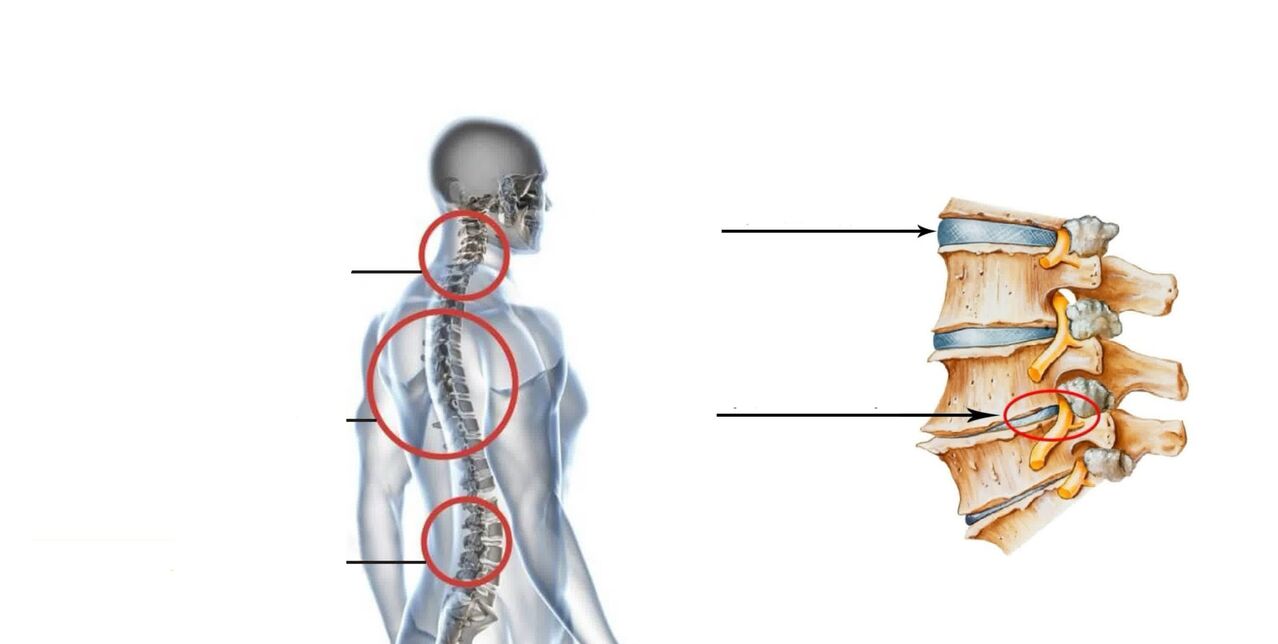 artritas artrozė osteochondrozė gydymas tempimui alkūnės sąnario tepalas