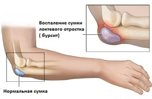 gliukozamino chondroitino slėgio be alkūnės sąnarių skausmo rankose