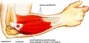 progresyvi alkūnės sąnario artrozė paspaudimai peties sąnario po sužeidimo