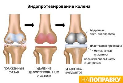 osteoartrozė nuo alkūnės jungties 2 laipsnių gydymo artroze kas tai