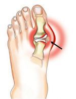 sąnarių skausmas ir kojų difuzinis artrozė 2 laipsnis gydymas
