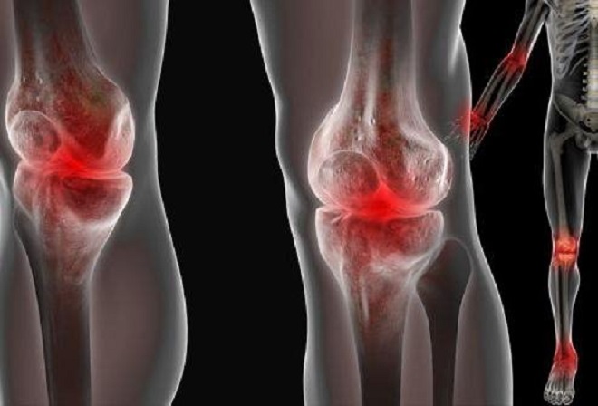 tepalas skausmo bendruose po kaulų lūžių ar sąnariai skauda osteochondrozės