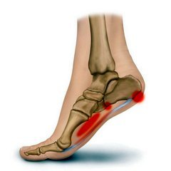 artrozė pėdų pėdų