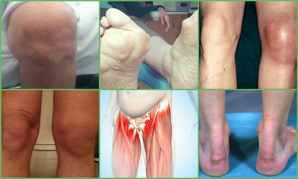 ženklai artrozės ir pėdų sąnarių ka vartoti nuo sanariu skausmo