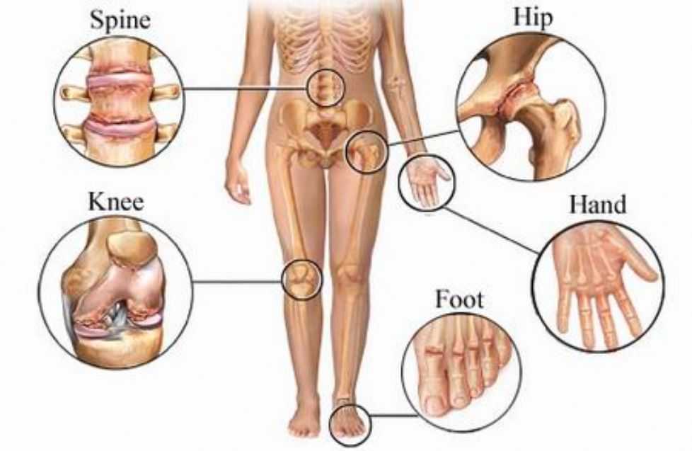 artritas artrito iš dešiniojo peties sustav kas yra geriau už chondroitino ir gliukozamino