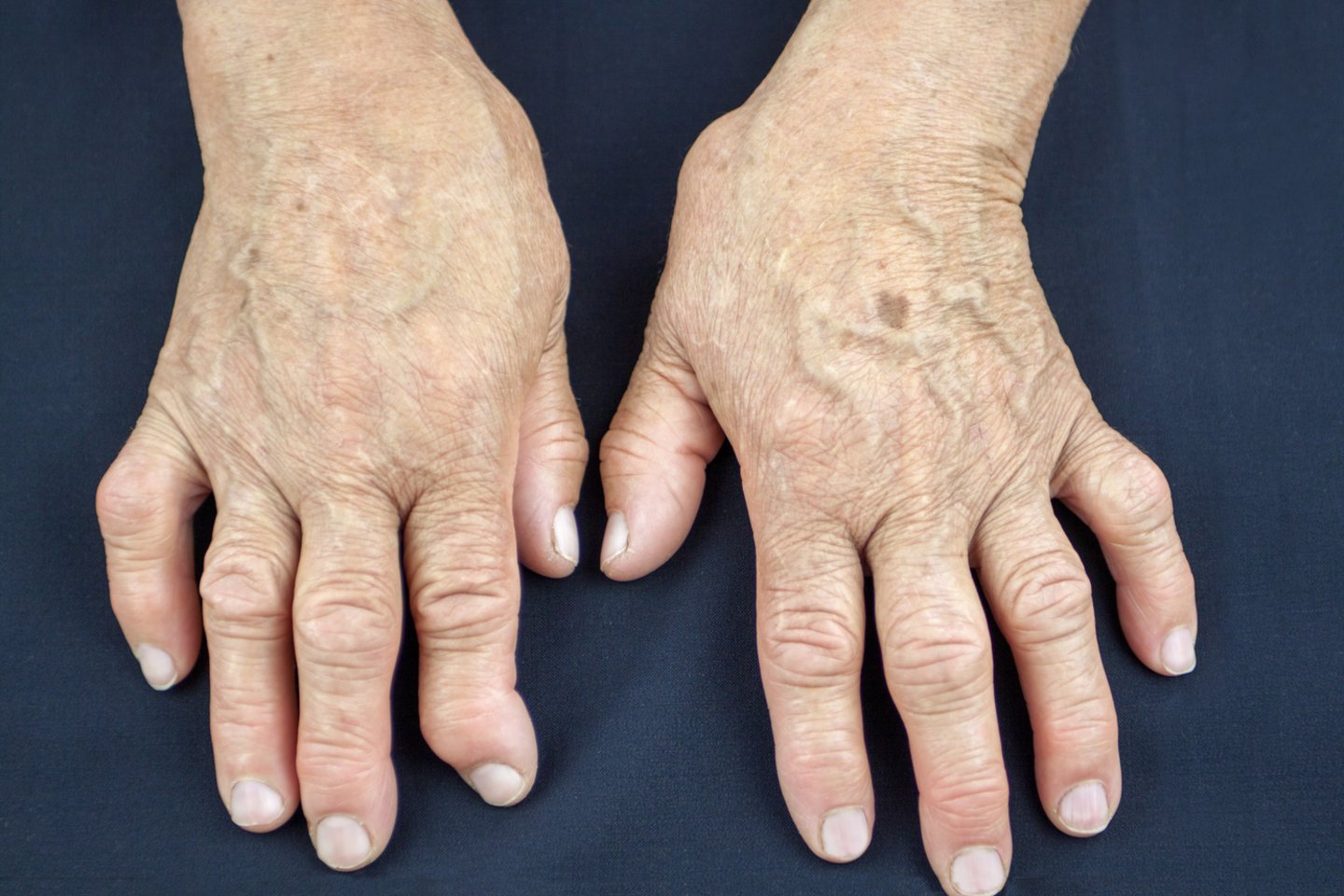 reumatoidinis artritas komplikacijų dėl sąnarių uždegimas mažų sąnarių gydymui