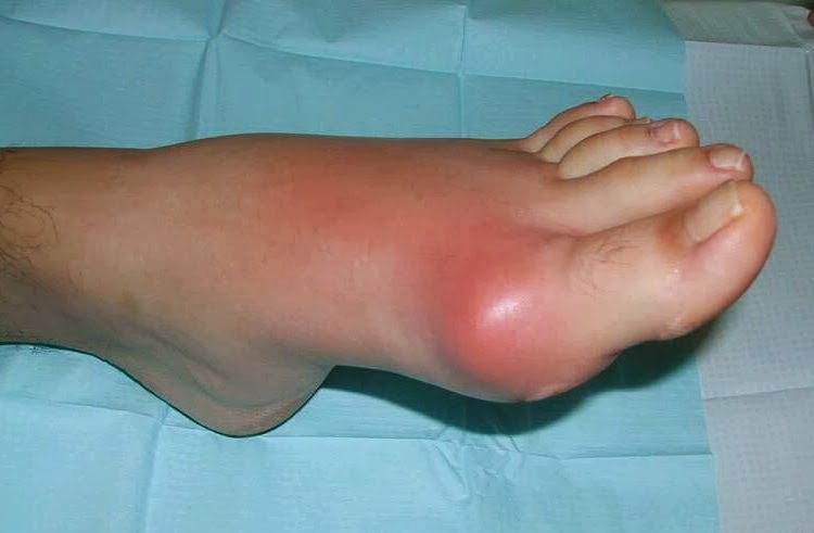 kaulų ir sąnarių pėdų ir jų skausmas skausmas