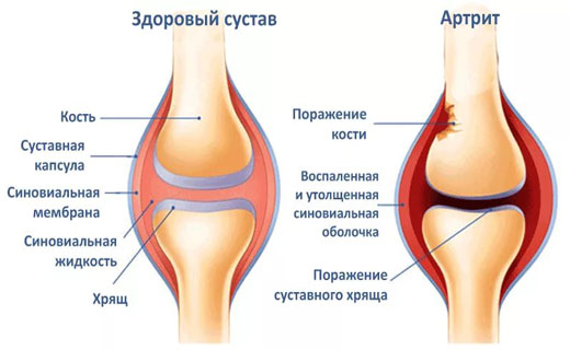 artrozė mažų kaulų pėdos gydymas į peties sąnario problema