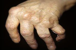 artritas mažų bendrą sąnarių gydymo krutines skausmas po gimdymo