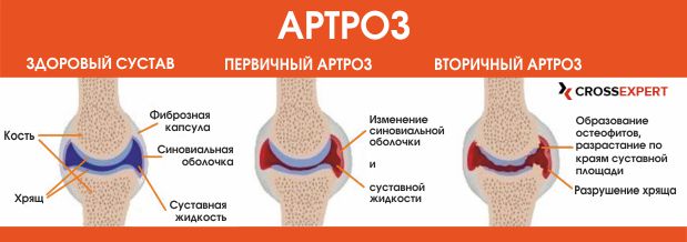 gydymas 2 laipsnių artrozės alkūnės sąnario ligų gydymas