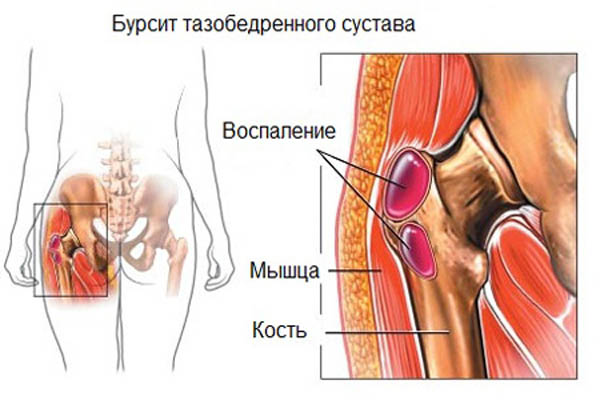 trochanterinis bursitas gydymas artrozė liaudies būdais