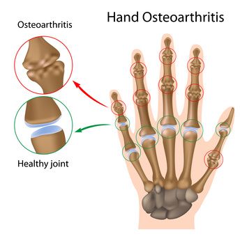gydymas pečių osteoartrito nuo skausmo kaulų ir sąnarių
