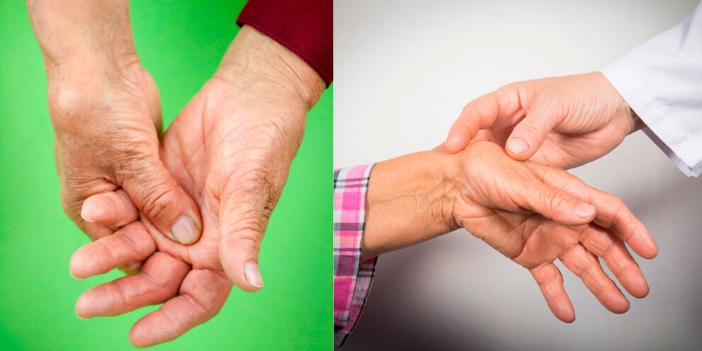 liaudies metodai gydant artrozės rankų