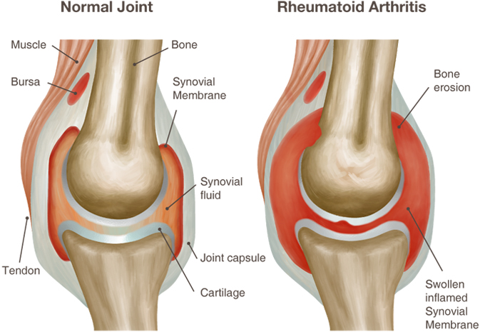 artritas ir artrozė gydymo apžvalgų