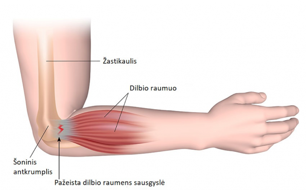 skauda kaires rankos raumenis blokados su skausmu peties sąnario