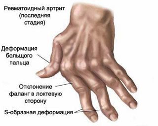skauda piršto sąnarys ant rankos gydymas
