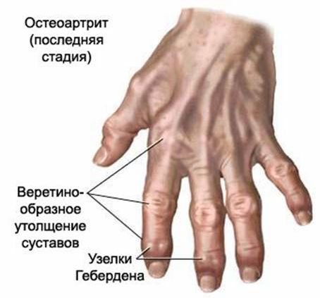vaistažolės su artrozė šepetys rankų gydymui pagal liaudies gynimo gydymas rankiniai bendrų žolelėmis