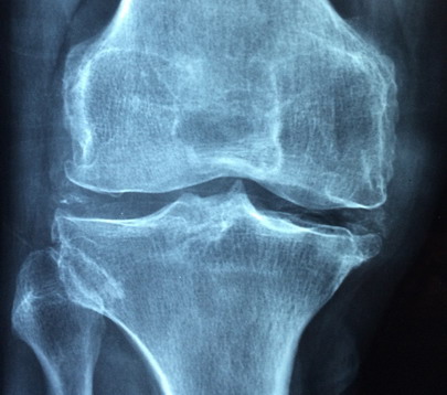 osteoma alkūnės sąnario gydymas tepalas nuo skausmo sąnariuose ir kainų