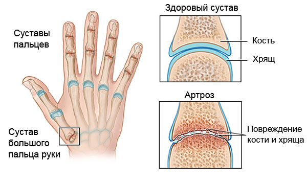 arthrisa artritas sąnariai
