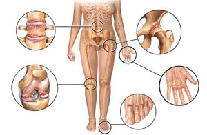 koks yra skirtumas tarp artrozė skirtumas nuo artrito rankų