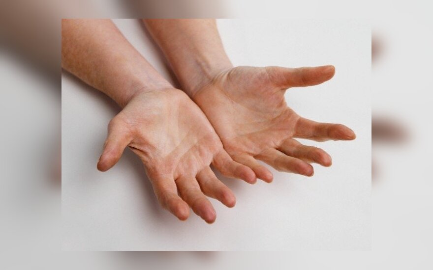 artritas rankų sulyginti gydymo grupėse efektyviausias tepalas su osteochondroze