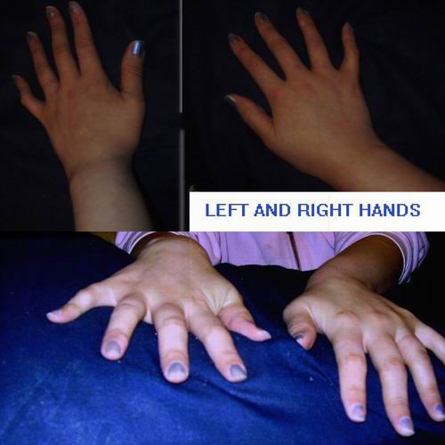 artritas hands kas yra liga
