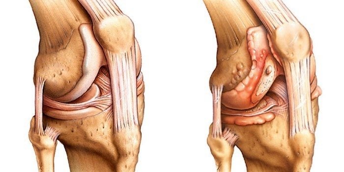 artritas iš kojų sąnarių sustaines sužeistas ot