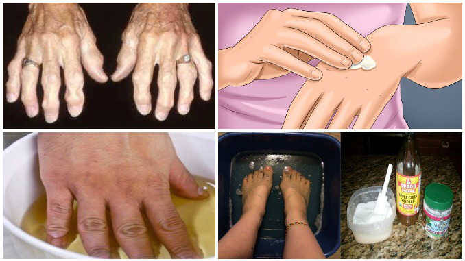 rankų skausmas rankose tulžies už sąnarių nuomonių gydymo