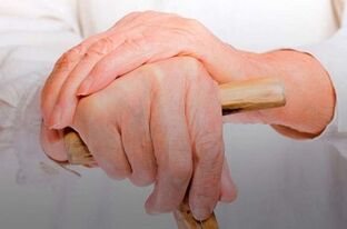 artritu sąnarių iš tepalo rankų pirštais artritas kaulų rankos