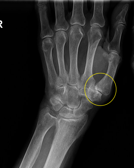 artrozė iš rankų gydymui nykščio artritas nykščio kairę šepečiai