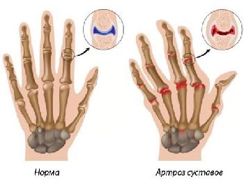 artrozė sustav žemutinės žydų gydymas liaudies medicina gydymas arrome
