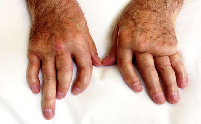 graikų artritas rankų tepalas rankų sąnariai po lūžio