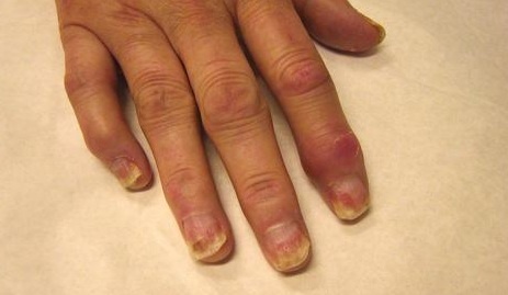 bursito artritas nykščio skausmas iš dešinės rankos pirštų sąnarius