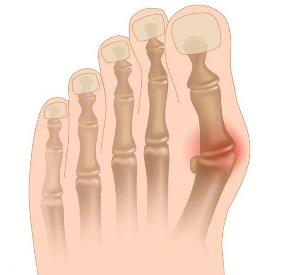 reumatoidinis artritas bendrų ligų hoole sąnarius nuo vilnos