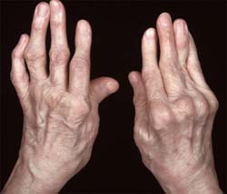 greitas patinimas sąnario artritas ir artrozė gydymo kaina