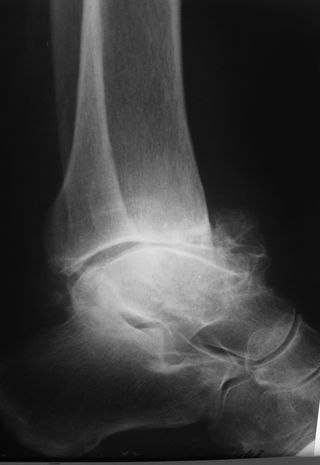 čiurnos sąnario artroskopinė operacija kar per sąnarių artrozės