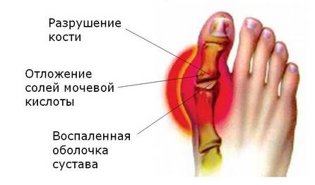 nuimkite sąnarių uždegimą rankose gydymas artrozės peties sąnarių 3 laipsnis