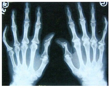 pirmieji požymiai artritu ir artrozė rankų gerklės sąnarius nuo kompiuterio