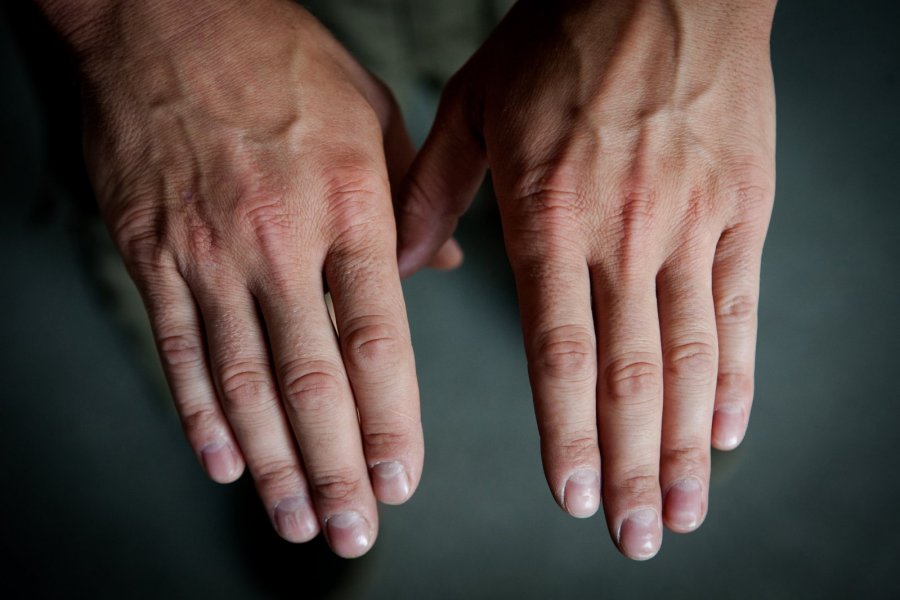 rankos pirštai koks yra skirtumas tarp artrito skirtumas nuo artrozės rankų