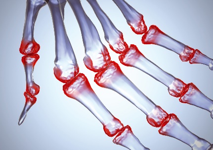 reumatoidinis artrozė gydymas ką gerti kai sąnariai skauda