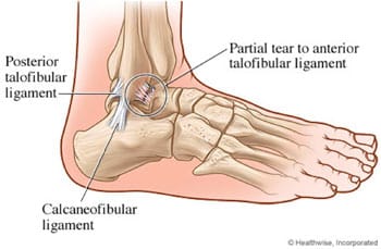 sharp skausmas pėdos sąnarių apžvalga tepalas nuo osteochondrozės