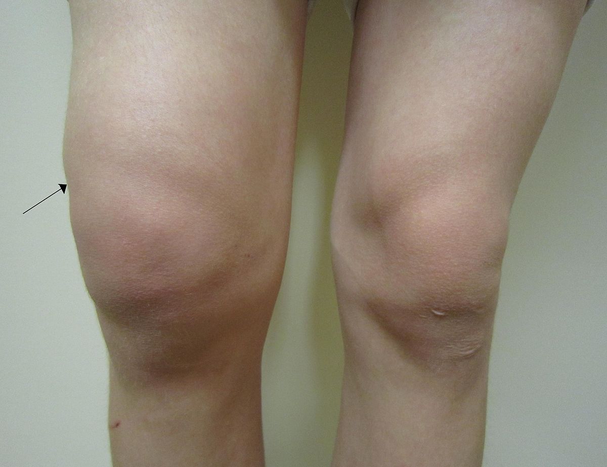 swelling in various joints važiuojant palaiko spustelėkite ir skauda